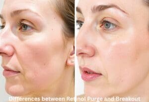differences between Retinol Purge and Breakout